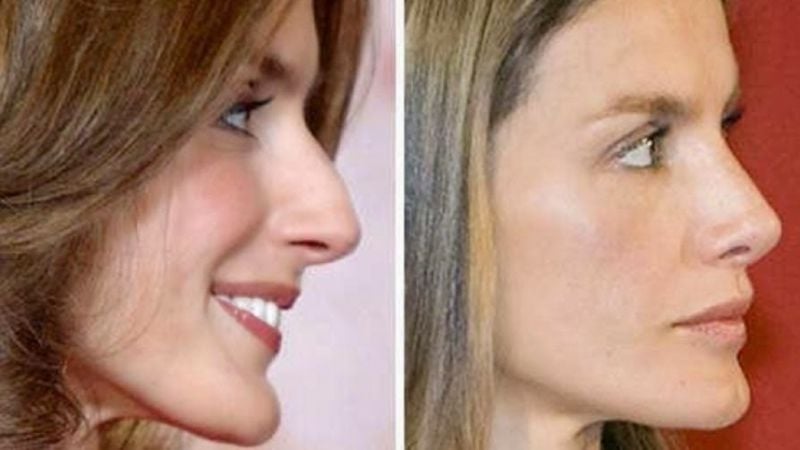 letizia-ortiz_RINOPLASTIA
