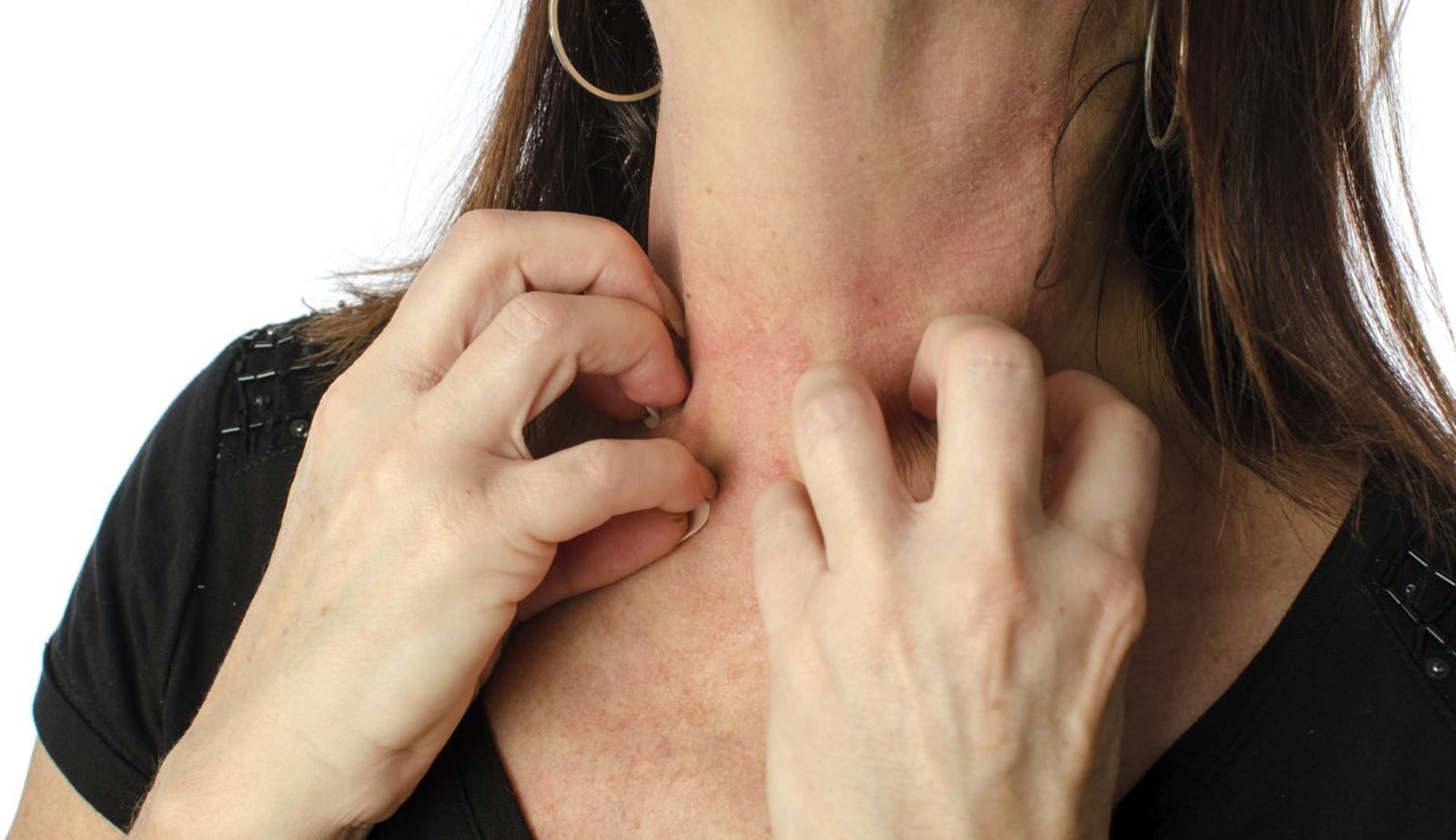 sarpullido 3
