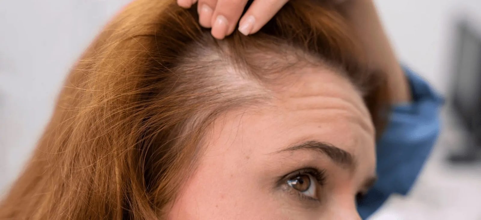 Caida-de-pelo-en-mujeres