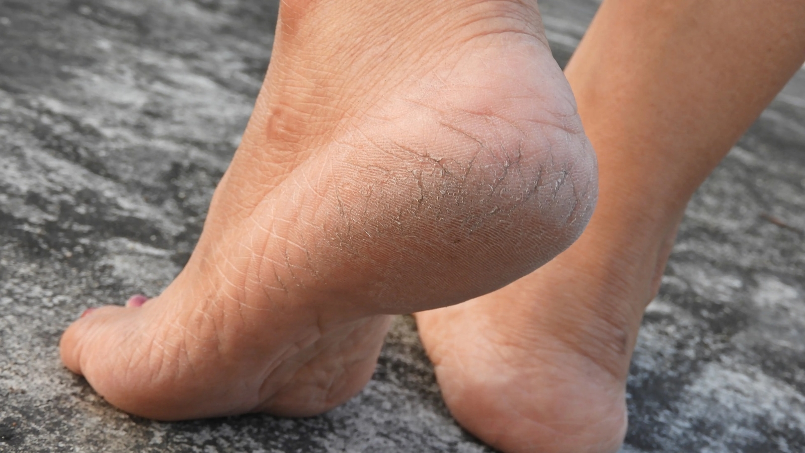 Cracked-heels-on-a-womans-foot_shutterstock_1013172730_16x9