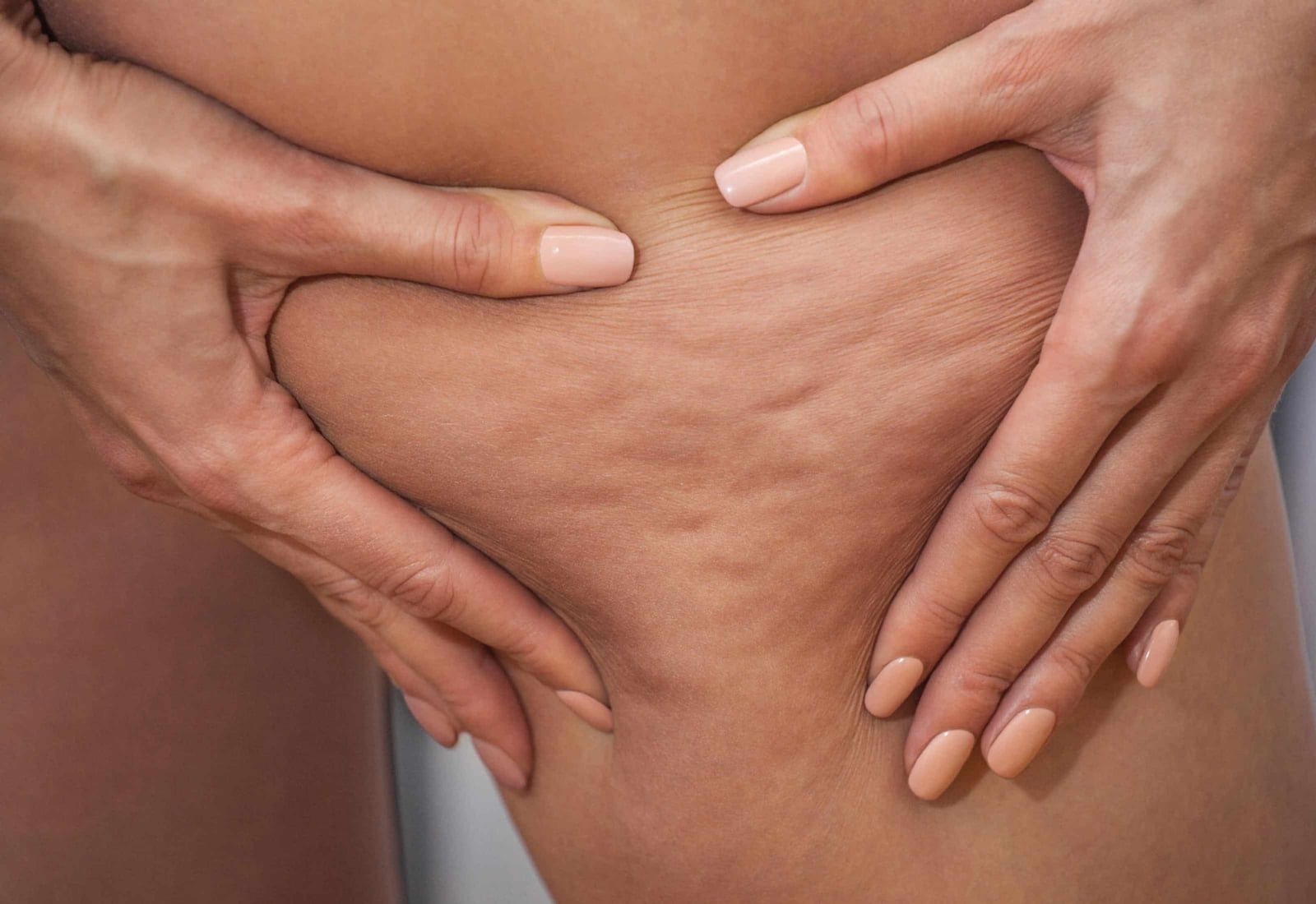 celulitis-gluteos (1)